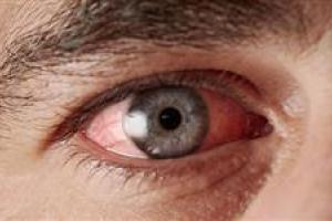 closeup-of-pink-eye-on-an-adult-man