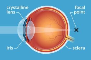 presbyopia-330x2202x