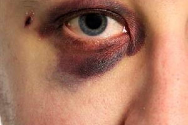 black-eye