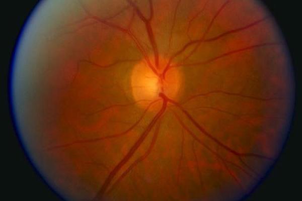 normal-optic-disc-and-blood-vessels-400px