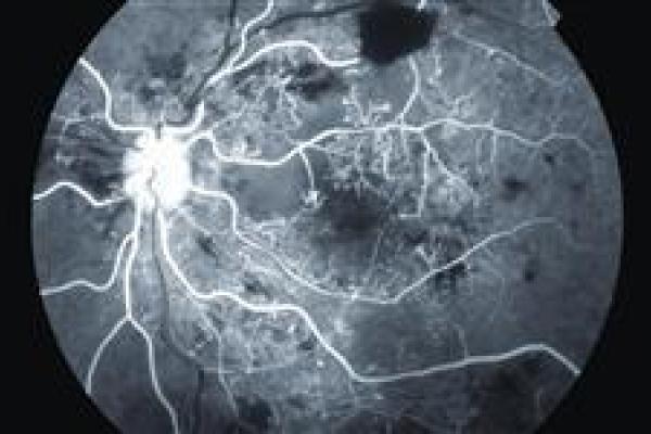 profil diabetické retinopatie diabetická retinopatie