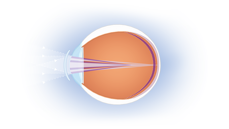 explaining_myopia_illustration_no_labels-800